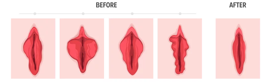 Vulva Augmentation