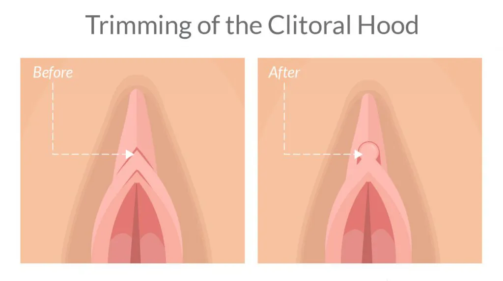 Clitoral Hood Reduction Illustration